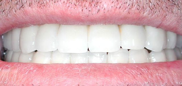44